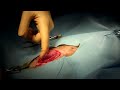 Cystotomy w/ Giant Stone