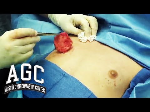 how to perform gynecomastia surgery