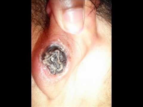 how to whiten keloid