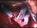 Middle Cerebral Artery Embolectomy Via Supercilliary Accesss 