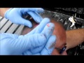 REMOVE THE CYST