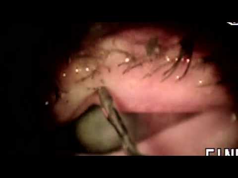 how to administer xalatan