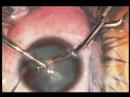 cataract surgery soft white lens phaco Uday Devgan surgeon cataract surgery soft white lens phaco Uday Devgan surgeon