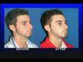 Rinoplasty Plastic Surgeon interviews patient