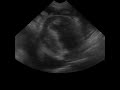 Ef pleural1.avi