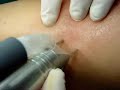 Percutaneous Laser - L�ser percut�neo