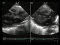 Truncus Arteriosus Truncus Arteriosus