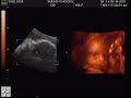 4D Ultrasound 4D Ultrasound