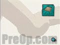 Myomectomy Vaginal Fibroid Removal, Patient Education