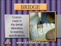 Bridge for teeth Los Angeles Dentist