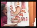 Gastric Ulcer, CA 2