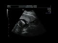 Ultrasound Week 15 Video