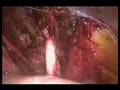 laparoscopic pelvic lymphadenectomy