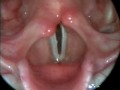 Laringoscopia (cuerdas Vocales en accion)
