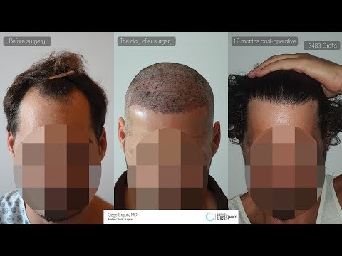 Hair Transplant Stunning Before And After Photos | Ozge Ergun MD | Plastic Surgery | Istanbul