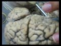 aula de neurologia parte 14 FIC 5 semestre 2007.2