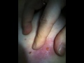 Cyst Part 2.5