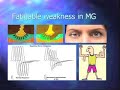 Fatigue, Sleep and Myasthenia Gravis