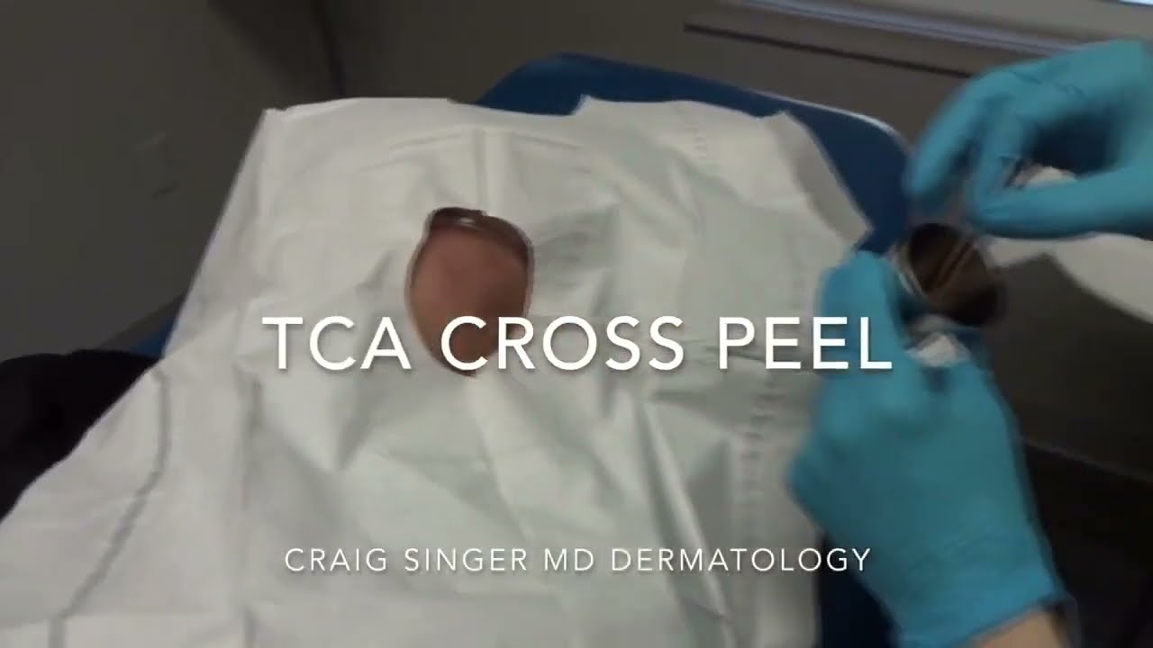 TCA Cross Peel Procedure