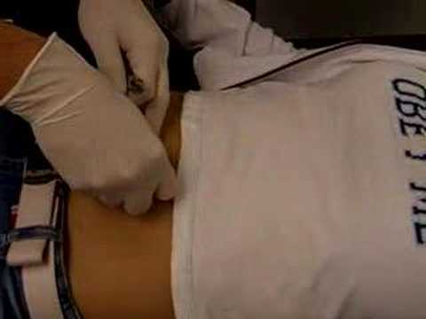 navel infection