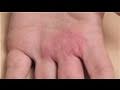 Dermatology Treatments : How to Diagnose Skin Rashes
