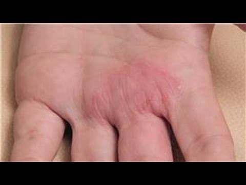 how to relieve rash itch