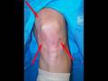 Dr. Mishra Discusses Meniscus (Cartilage) Tears