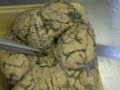 Anatomy - Arteries of the Human Brain