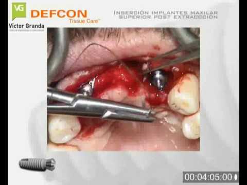 cirugía dental - Colocacion de implantes dentales en el maxilar superior , con extracciones simultaneas , con y sin levantamiento de colgajo. Los implantes dentales son de la...