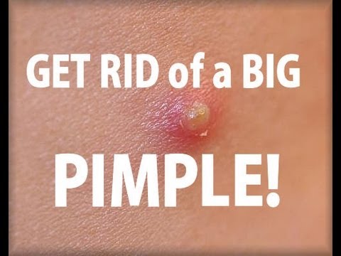 how to cure big pimples