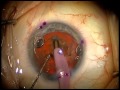 Cataract Surgery for Astigmatism - Toric Intraocular Lens Implantation