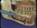 Dental Anatomy: Mandibular Molars