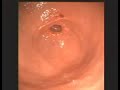 Endoscopia Endoscopia