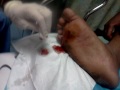 cyst on my foot