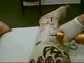 Full leg cast being taken off Full leg cast being taken off