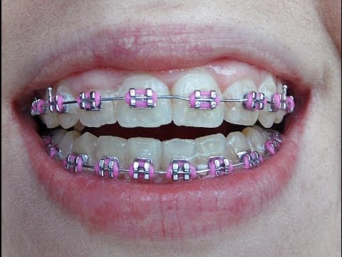 aparat - Witajcie, dziś filmik na temat aparatu ortodontycznego. Mam nadzieję,że dla wielu z Was będzie pomocny :) BLOG* http://martawojnarowskamakijaz.blogspot.com/ ...