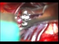 brain aneurysm clipping