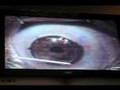 la jolla lasik eye surgeon