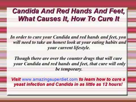 how to cure fungus on hands