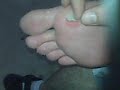 Flapping Callous