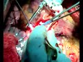 Beating heart CABG