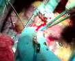 Beating heart CABG