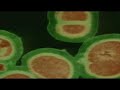 Staph Survivor Talks To KMBC