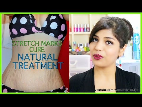 how to cure stretch marks