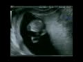 echographie