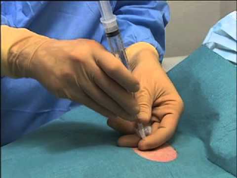 how to drain pneumothorax