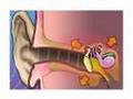 PreOp®  Patient Education Myringotomy Insertion of Tube