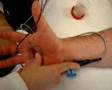 videos de Elettroneurografia Ulnare Sensitivo Antidromico