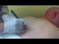 My Cyst Backulation