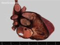 Virtual heart pumps up the realism